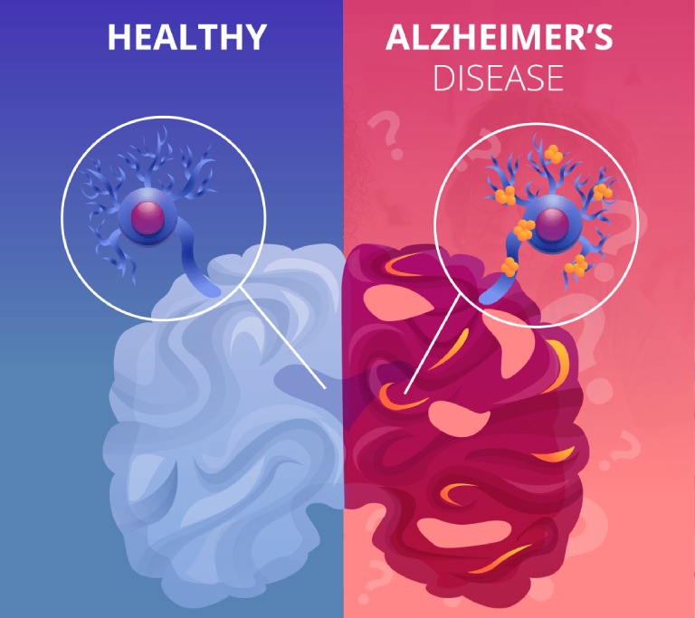 mô hình não bệnh Alzheimer