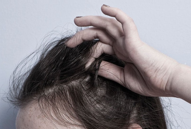 hội chứng nghiện nhổ tóc